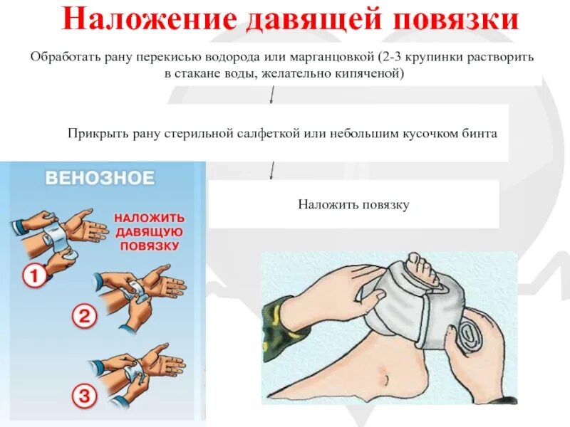 Техника наложения давящей повязки при кровотечении. Налодениедавящей повязки. Наложение давящей повязки. Наложение давящей повязки на рану. Наложение жгута и давящей повязки.