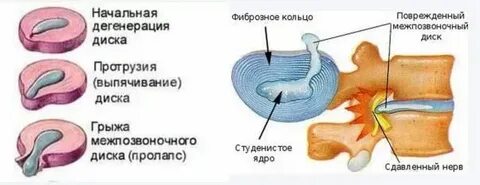 Пролабирование диска позвоночника что это