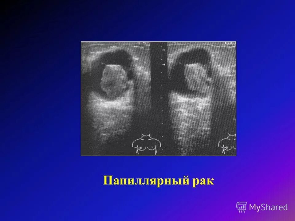 папиллярный рак молочной. аденокарцинома щитовидной железы гистология. карцинома молочной железы на узи. медуллярная карцинома щитовидной железы гистология. папиллярная аденокарцинома желудка.