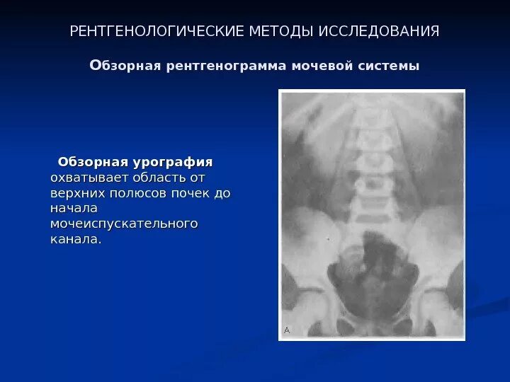 Экскреторная урография контрастное вещество. Рентгеноконтрастное исследование мочевыделительной системы. Рентгенологические методы исследования в урологии. Методика проведения внутривенной экскреторной урографии. Рентгенологические методы мочевыделительной системы.