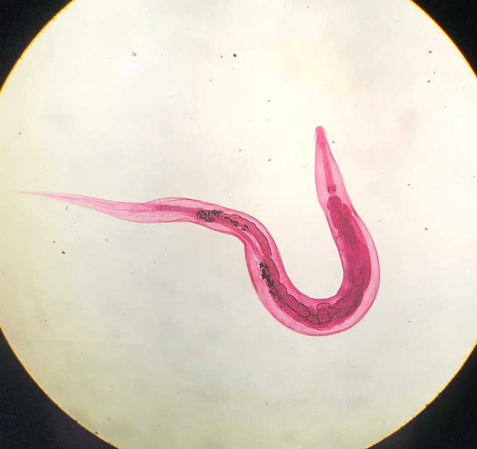 Ascariasis is a Disease Caused by the Parasitic Roundworm Ascaris Lumbricoides f