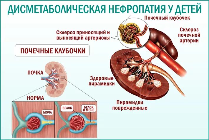 Кровь в почках у мужчин. Дисметаболическая нефропатия у детей. Симптомы дисметаболической нефропатии. Классификация дисметаболической нефропатии. Классификация дисметаболической нефропатии у детей.