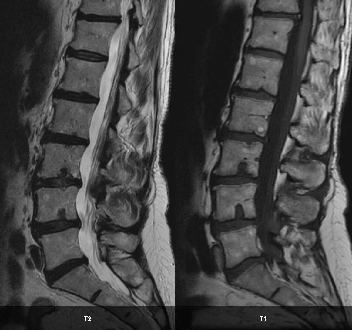 Грыжа Шморля l5 позвоночника. Грыжи Шморля l1 l2 l3 l4. Опухоль в поясничном отделе