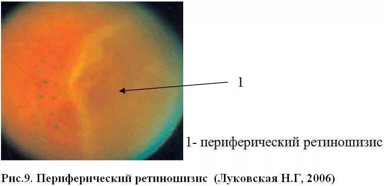 Периферические ретинальные дегенерации. Ретиношизис сетчатки глаза. Ретиношизис дистрофия сетчатки. Периферический ретиношизис. Периферический буллезный ретиношизис.
