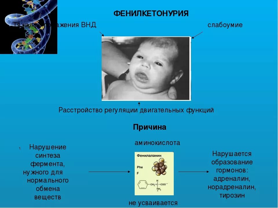 Фенилкетонурия моногенное заболевание возникающее в результате. Фенилкетонурия олигофрения. Фенилкетонурия формы болезни. Фенилкетонурия мутация Гена.