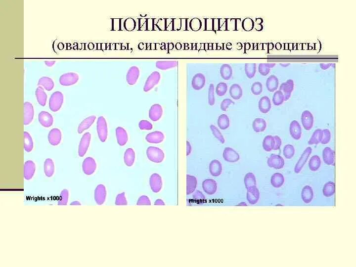 Пойкилоцитоз эритроцитов это. Патология эритроцитов пойкилоцитоз. пойкилоцитоз формы эритроцитов. пойкилоцитоз это изменение формы эритроцитов. патологические формы эритроцитов пойкилоцитоз.