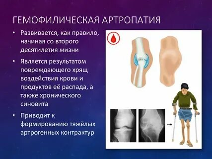 Дегенеративные изменения суставов