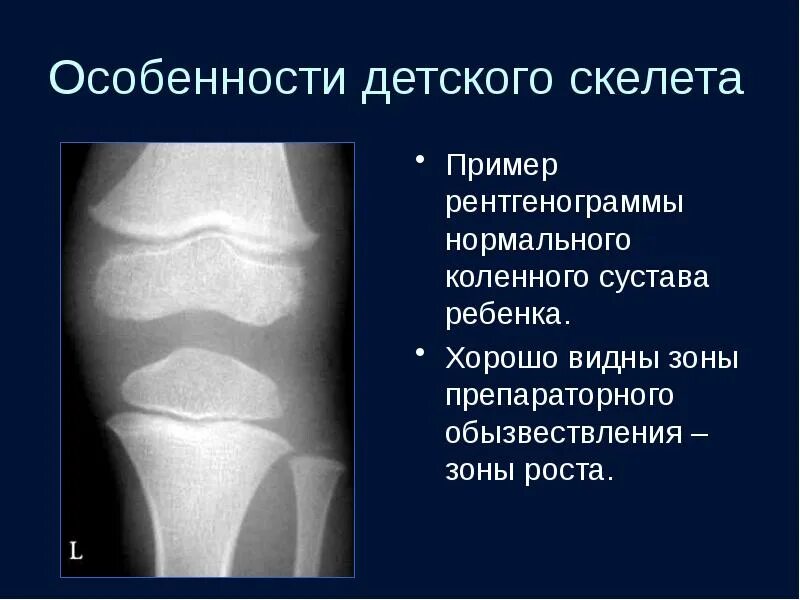 Обызвествление в проекции