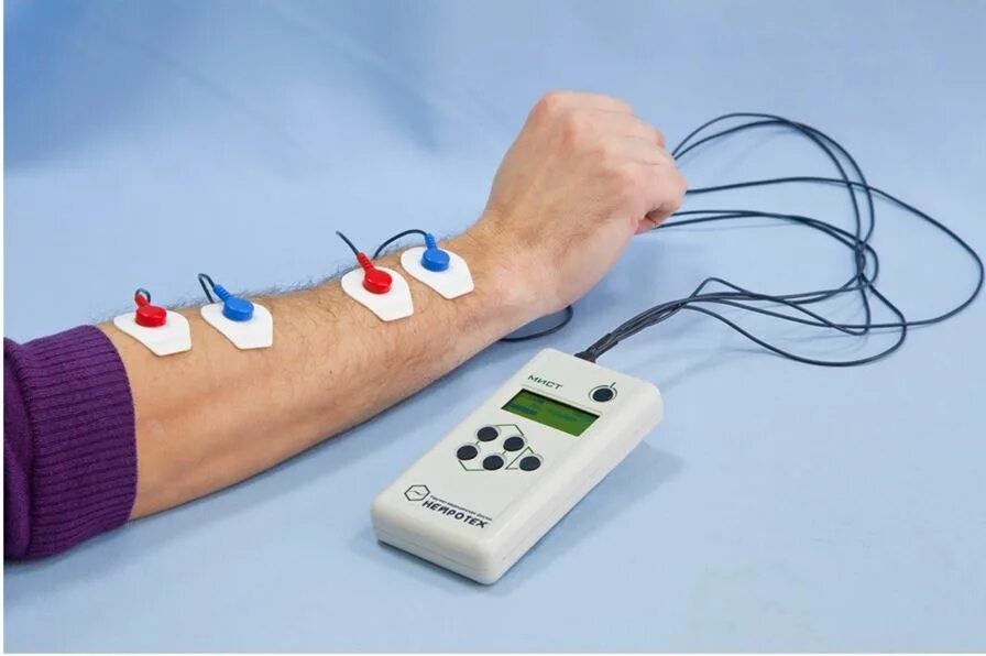 Электростимуляции электростимуляция мышц. Стимуляция нервных. Чрескожная электрическая стимуляция нервов. Чрескожная электростимуляция ддт. Электропунктурная рефлексотерапия аппараты.