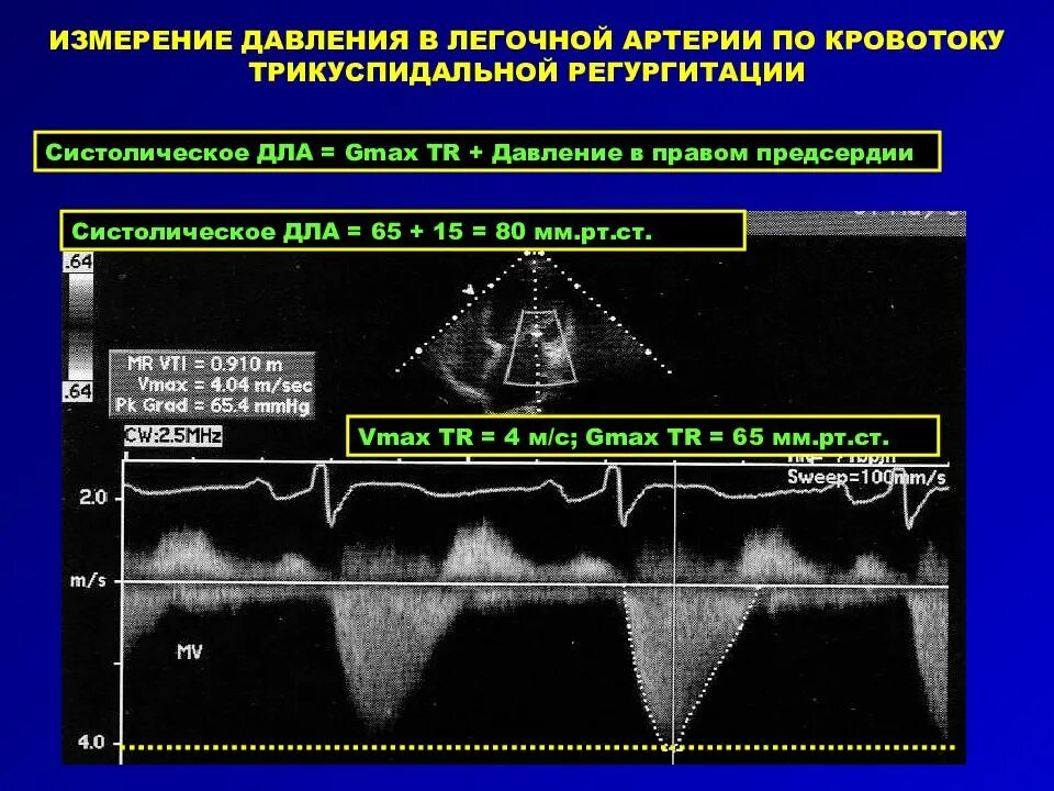 Тк регургитация 1. Эхокардиография физиология. Трикуспидальную регургитацию. Степень трикуспидальной регургитации по допплеру. Кровоток.