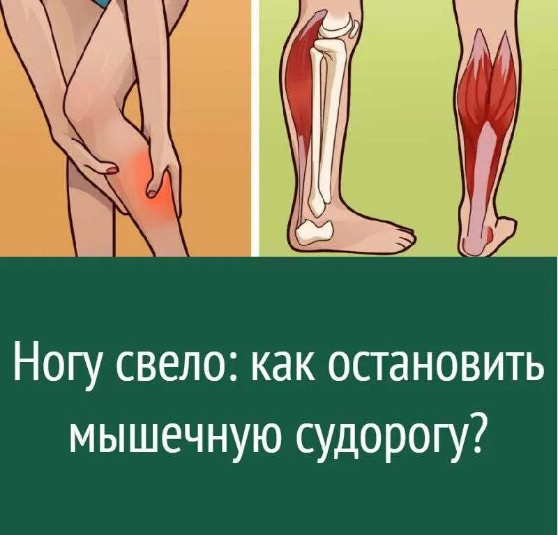 Сводит мышцы ног. Судорога икроножной мышцы. Мышечные спазмы в ногах. Судороги нижних конечностей.