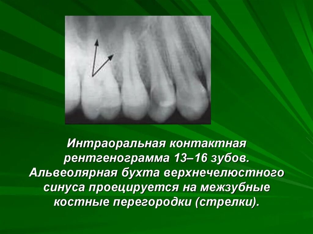 Бухта пазух. Альвеолярная бухта верхнечелюстного синуса. интраоральная рентгенография. альвеолярная бухта верхнечелюстной пазухи.