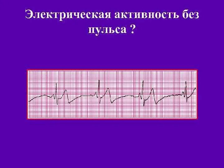 Электрическая активность без пульса. Электрическая активность без пульса на ЭКГ. Электрическая активность без пульса (электромеханическая. Беспульсовая электрическая активность на ЭКГ.