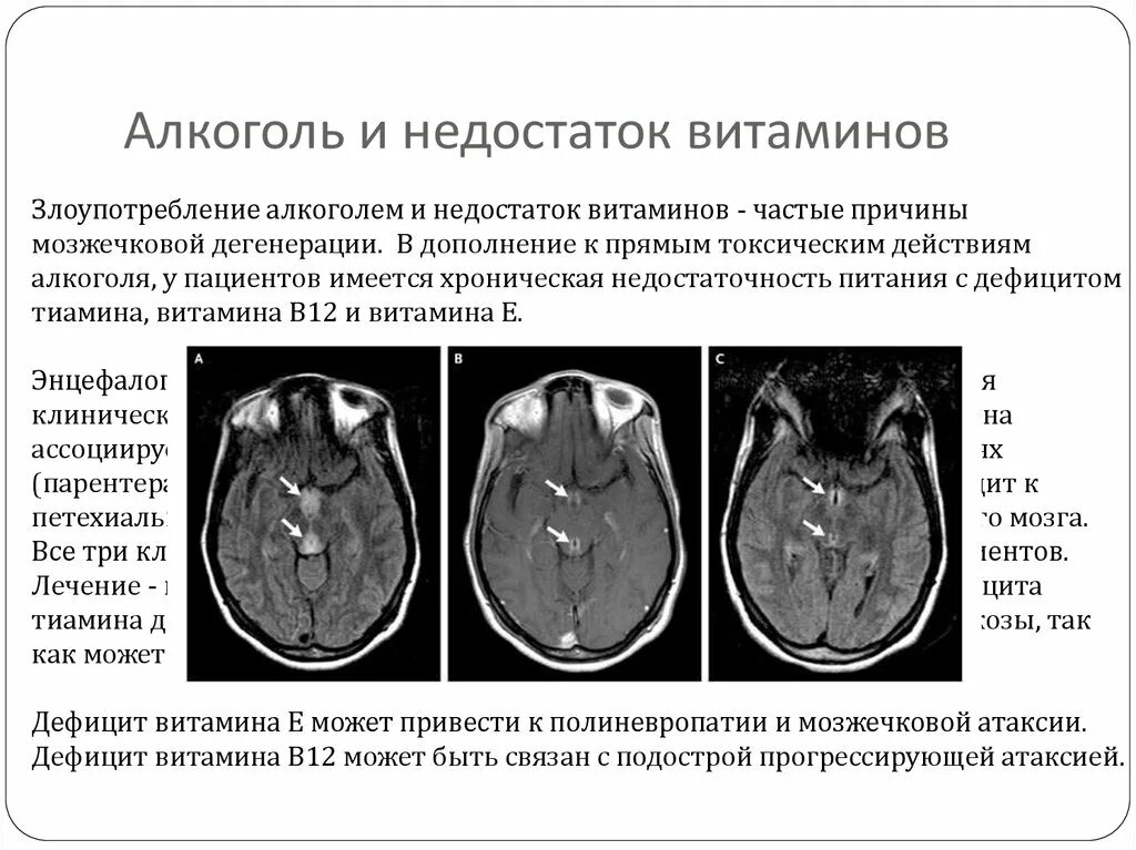 Дегенерация головного. Мозжечковая дегенерация мрт. Мозжечковая атаксия мрт. Алкогольная дегенерация мозжечка.