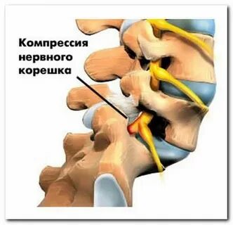 Компрессионная грыжа
