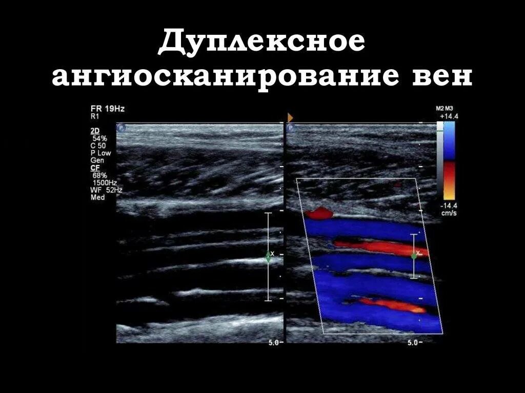 Дуплексное нижних конечностей. Ультразвуковая допплерография артерий нижних конечностей. Ультразвуковое компрессионное дуплексное ангиосканирование. Ультразвуковая допплерография вен нижних конечностей. Дуплексное сканирование сосудов (артерий и вен) нижних конечностей.