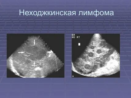 Нефолликулярная лимфома