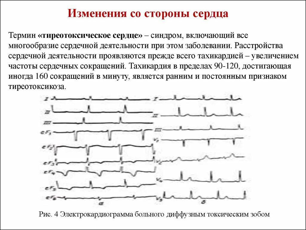 Изменения на экг при тиреотоксикозе. Экг при гипотиреозе. Экг при гипотиреозе. Экг при стенокардии фк3. Экг при гипотиреозе.