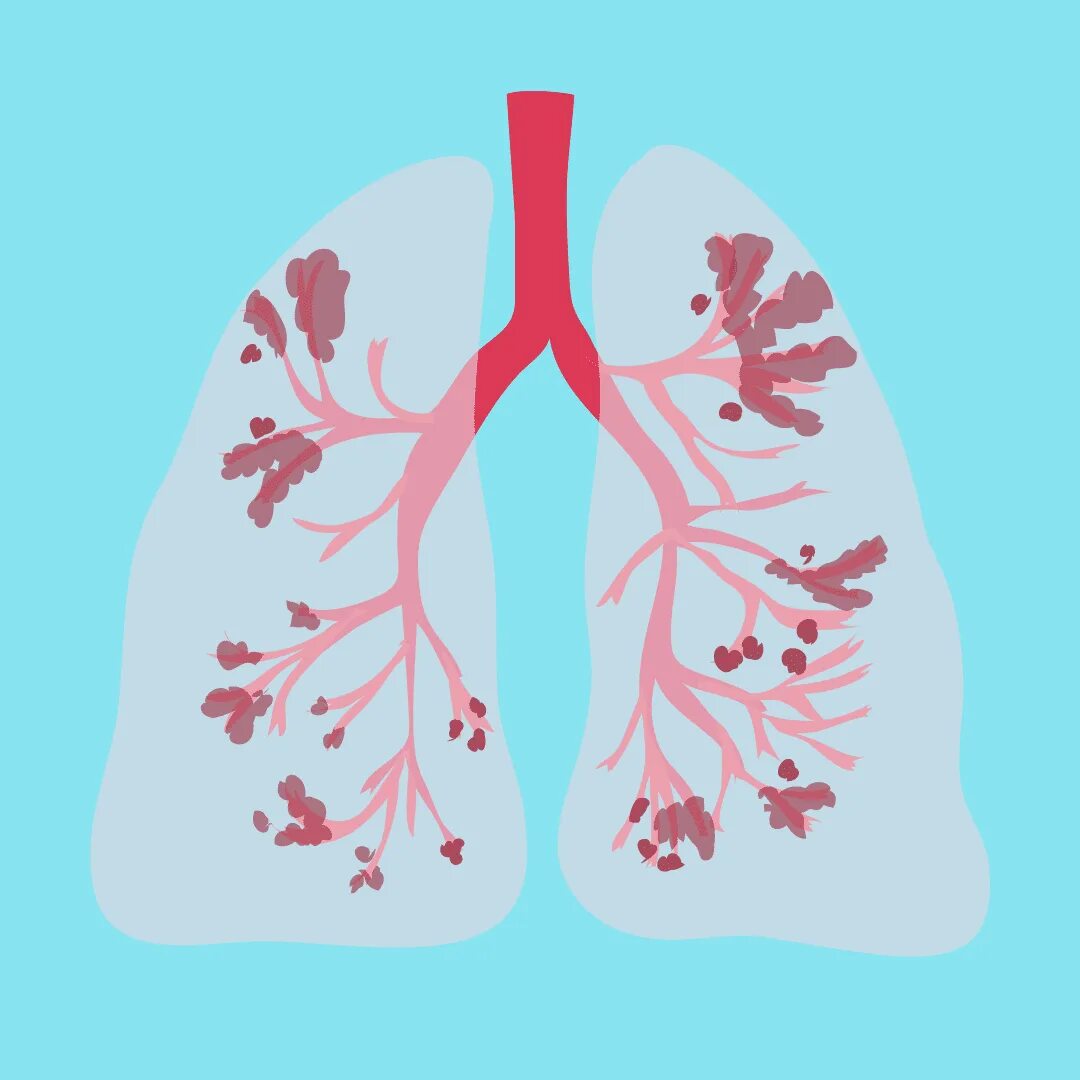 Заболевания органов дыхания. Заболевания легкиких. Lung disease. Lung disease. Легкие анатомия плакат.