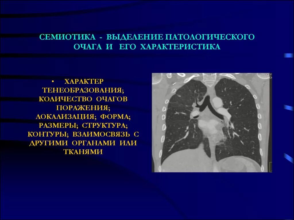 Структура очагов поражения. Семиотика заболеваний легких. Рентгенологическая семиотика заболеваний легких. Характер патологического очага. Локализация патологического очага..