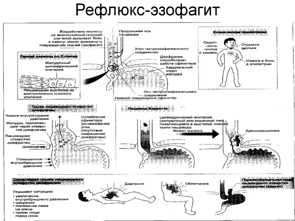 Что пить при рефлюксе. Лекарства при рефлюксе желудка. гастрит рефлюкс эзофагит. эзофагит рефлюкс кислотный. симптомы рефлюкса эзофагита.
