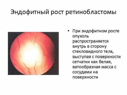 Экзофитный рост опухоли