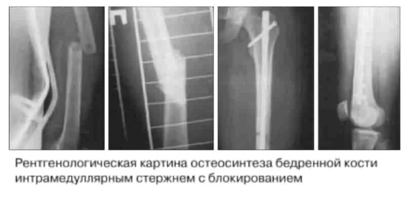 Перелом бедра со смещением прогноз