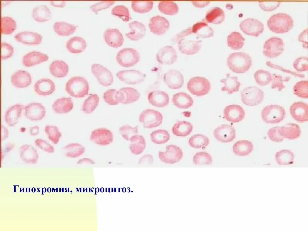 Гипохромия эритроцитов. Гипохромия микроцитоз. пойкилоцитоз микроцитоз гипохромия. микроцитоз анемия. гипоферримия, гипохромия, микроцитоз.