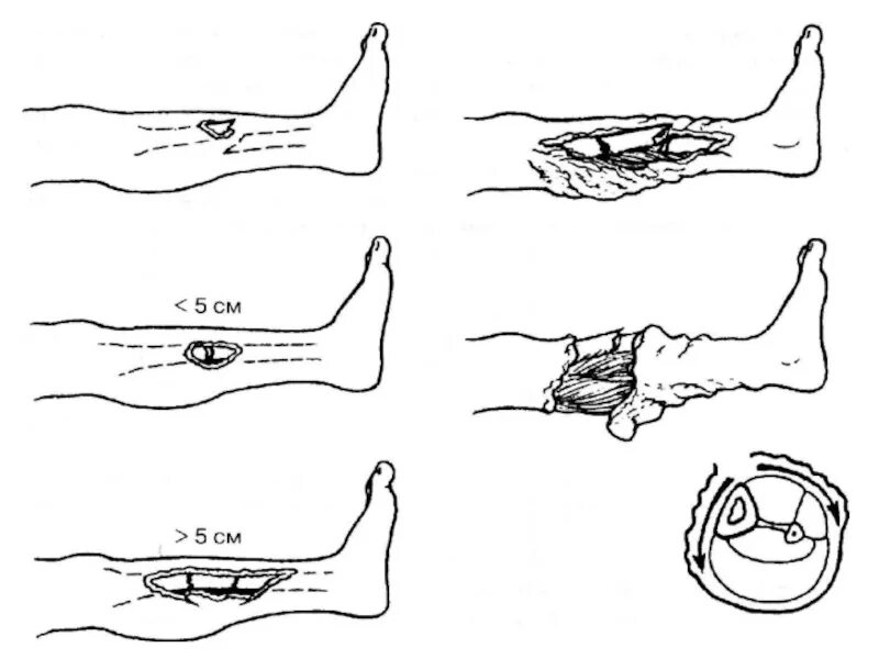 Степени открытого перелома. Открытый перелом ноги степень тяжести. Перелом голени открытый перелом. Открытый перелом 3 степени ноги. Открытый перелом схема.