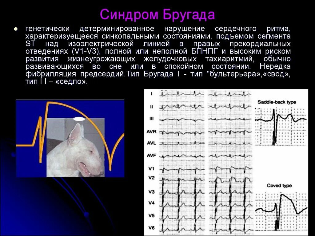 Синдром бругада экг признаки. Экг-критерии синдрома бругада 3 типа. Синдром ранней реполяризации желудочков. Феномен бругада на экг. Синдром бругада экг признаки.