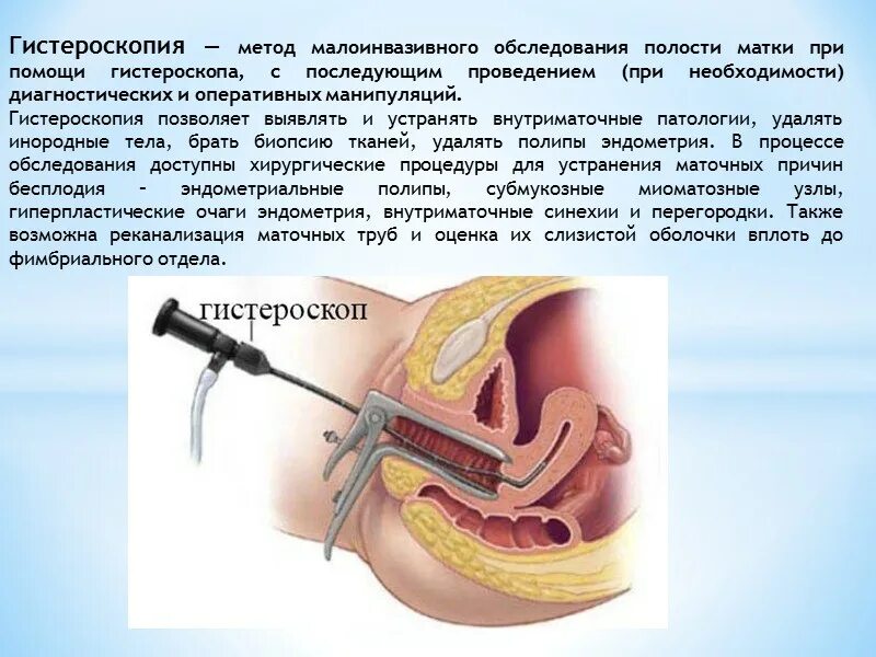 Гистероскопия матки что это такое как проходит. Метод обследования гистероскопия. гистероскопия полости матки. гистероскопия методика. методы обследования полости матки.