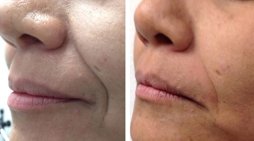 4д омоложение отзывы