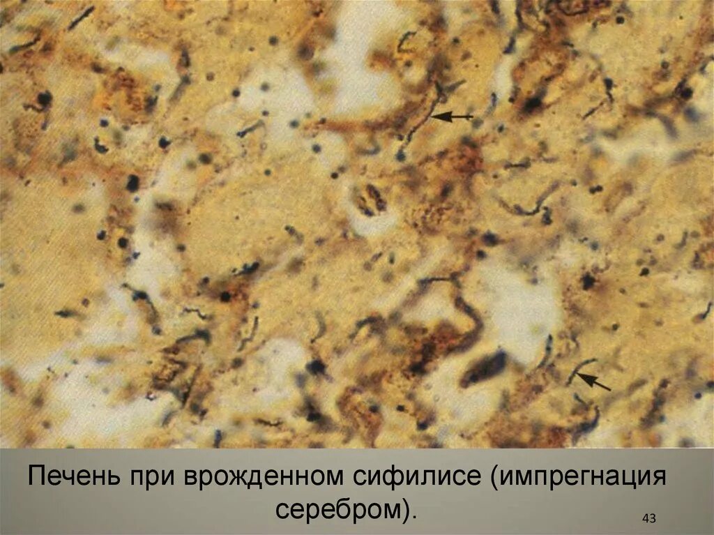 Как выглядит сифилис глаза Ficheiro:Syphilis a treatise on etiology, pathology, diagnosis, prognosis, pro