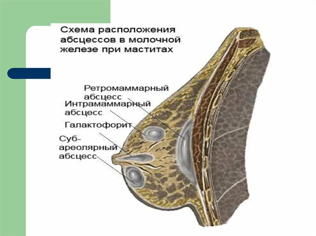 Послеродовый мастит. Ретромаммарный мастит. Гнойный лактационный мастит. Субареолярный абсцесс. Молочные железы.