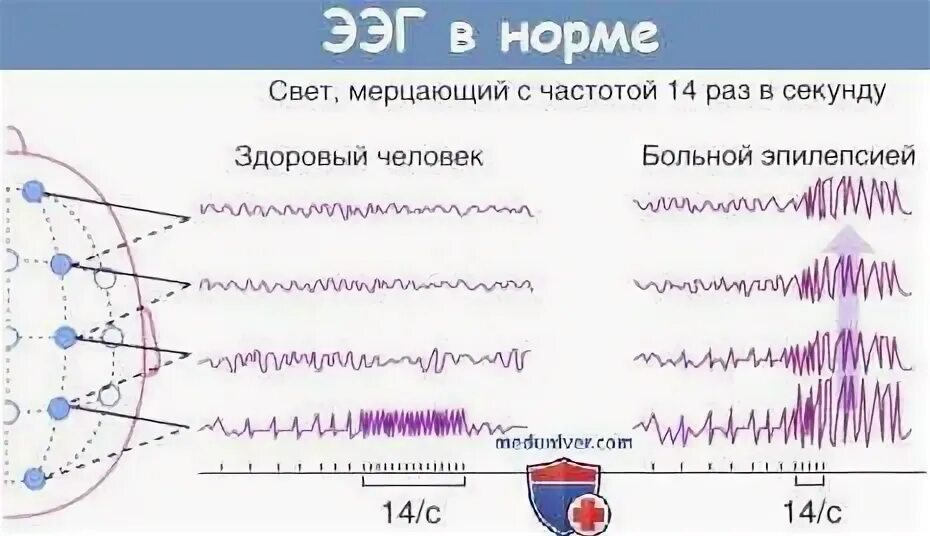Как делают энцефалограмму детям. Как делают энцефалограмму детям