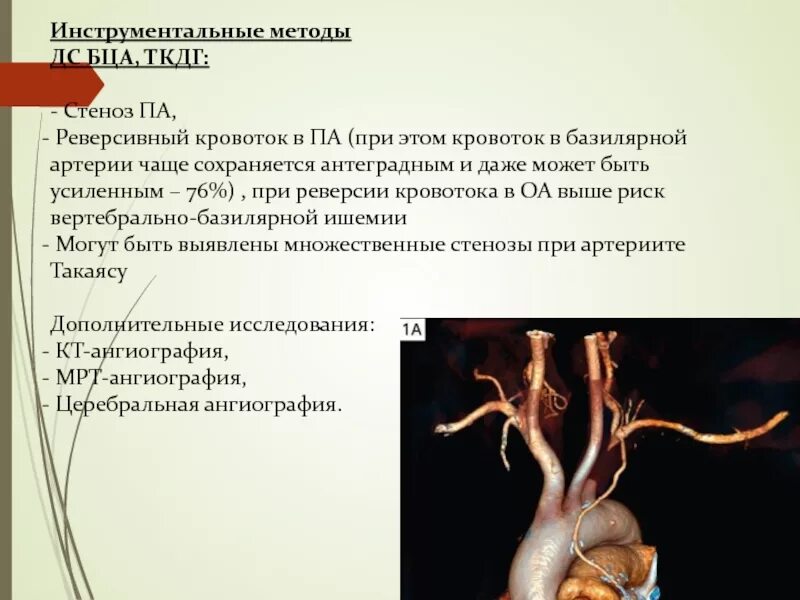 Стенозирование бца