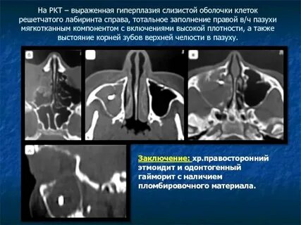 Утолщенная слизистая