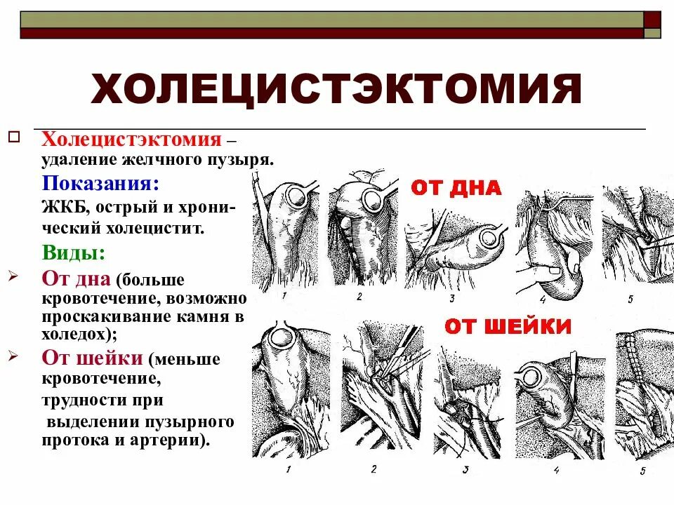 Острый холецистит хирургические. Холецистэктомия (показания, техника операции).. Этапы операции холецистэктомии ( от шейки). Холецистэктомия от дна этапы операции. Холецистэктомия от дна и от шейки.