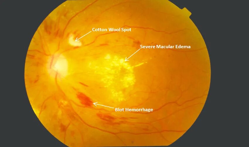 Макулопатия макулярный отек. Диабетический макулярный отек. Эпиретинальная мембрана сетчатки. Кистовидный макулярный отек сетчатки. Жидкость в сетчатке