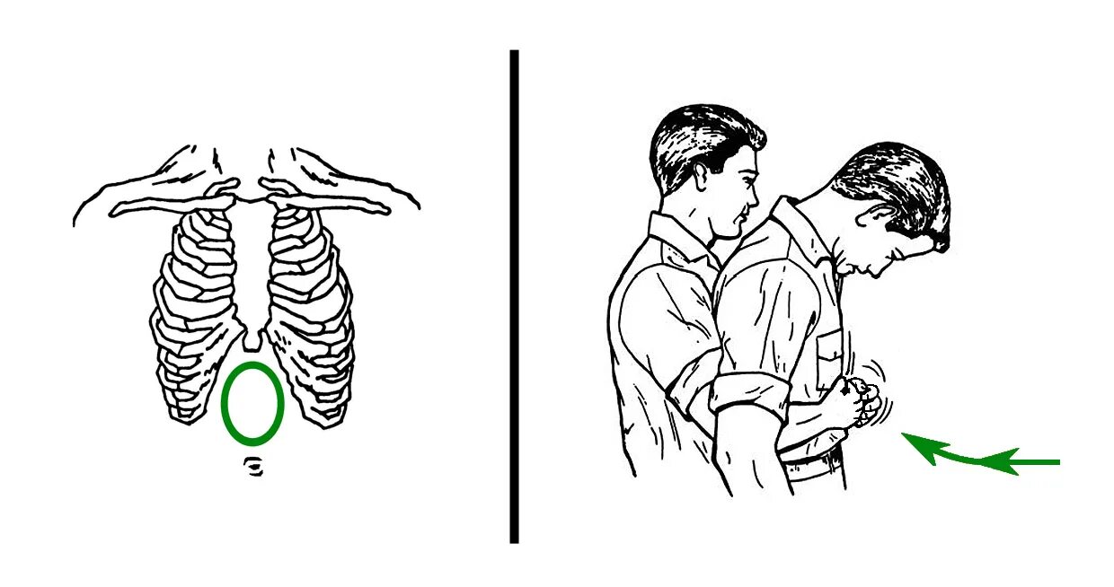Маневр Геймлиха. Прием Геймлиха. Метод Геймлиха. Метод Хеймлиха. Маневр хеймлиха это сколько толчков