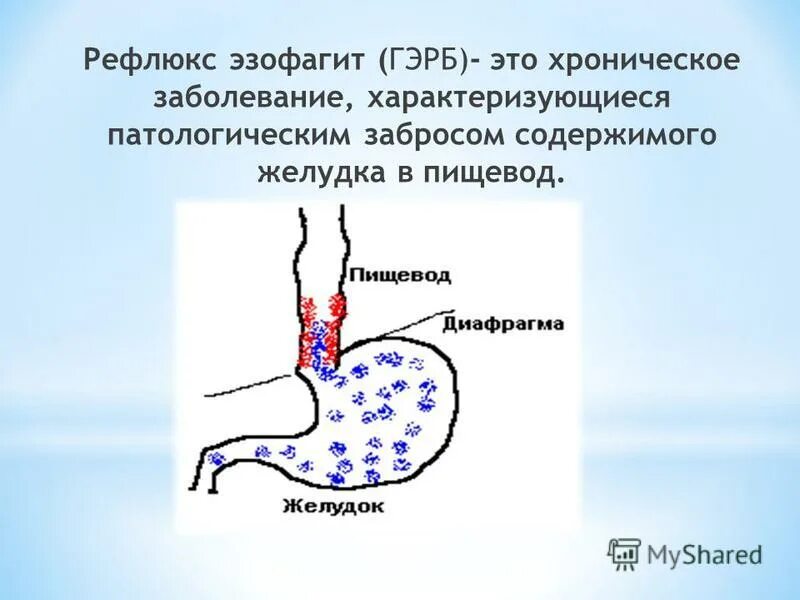 Упражнения при рефлюксе. Синдром рефлюкс эзофагита. Рефлюксная болезнь желудка.