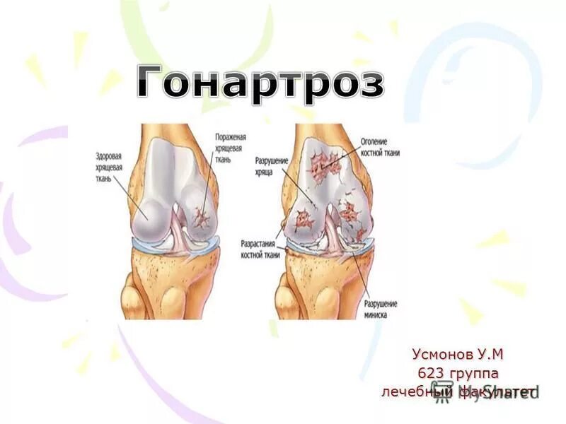 Деформирующий артроз коленного сустава 1. Остеофиты коленного сустава. Чем отличается гонартроз от артроза коленного. Чем отличается гонартроз от артроза коленного. Остеоартрит (артроз, дегенеративные заболевания суставов).