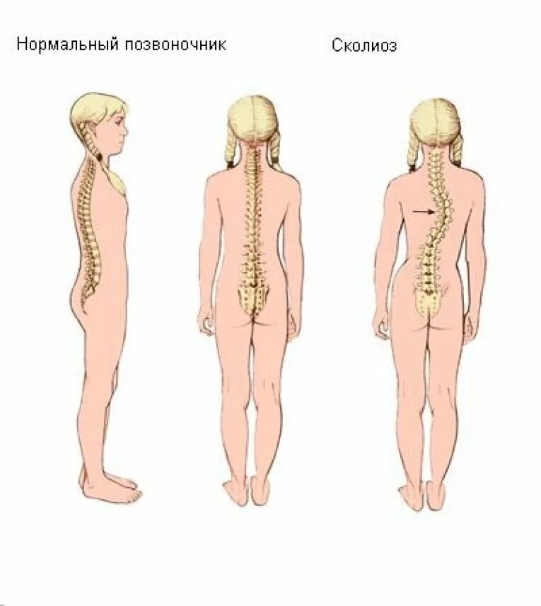 Сколиоз позвоночника s-образный грудопоясничный. Грудопоясничный сколиоз 2 степени упражнения. Идиопатический правосторонний грудопоясничный сколиоз 1 степени. Левосторонний грудопоясничный сколиоз 1 степени.