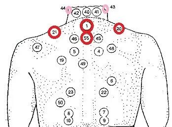 Банки при болях в спине. Хиджама атлас точек. Хиджама кровопускание схема. Схема хиджама точки на спине.