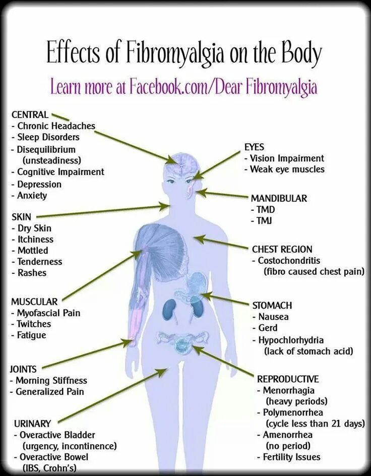 Фибромиалгия симптомы причины и лечение. Фибромиалгия неврология. Болезнь Фибромиалгия. Фибромиалгия симптомы симптомы. Симптомы фибромиалгии у женщин.