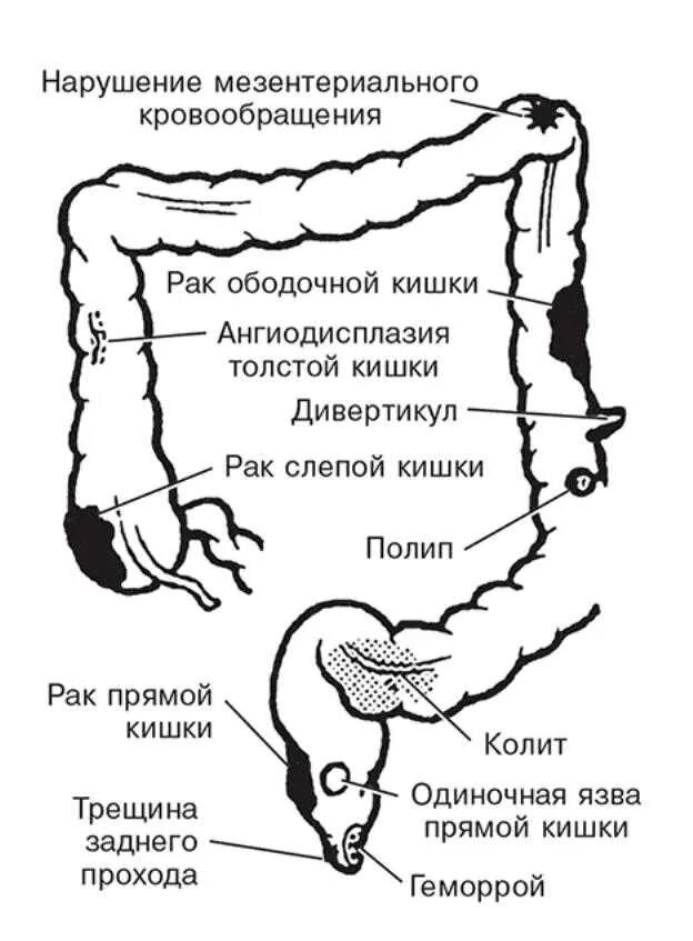 Урчат кишки почему. Опухоль сигмовидной кишки стадии. Лимфоузлы брыжейки толстой кишки. Дивертикулит слепой кишки. Внутри ободочной кишки.