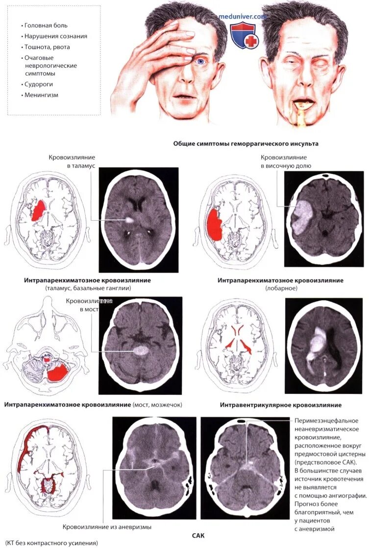 Стволовой ишемический инсульт на кт. Ишемический или геморрагический инсульт на кт. Осложнения ишемического инсульта мозга. ОНМК геморрагический инсульт. Инсульт 2 степени