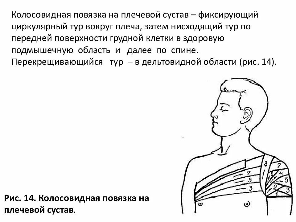 Плечевая повязка алгоритм. Наложение повязки на плечо алгоритм. Повязка колосовидная на плечо и плечевой сустав. Техника наложения колосовидной повязки на плечевой сустав. Алгоритм наложения колосовидной повязки на плечо.