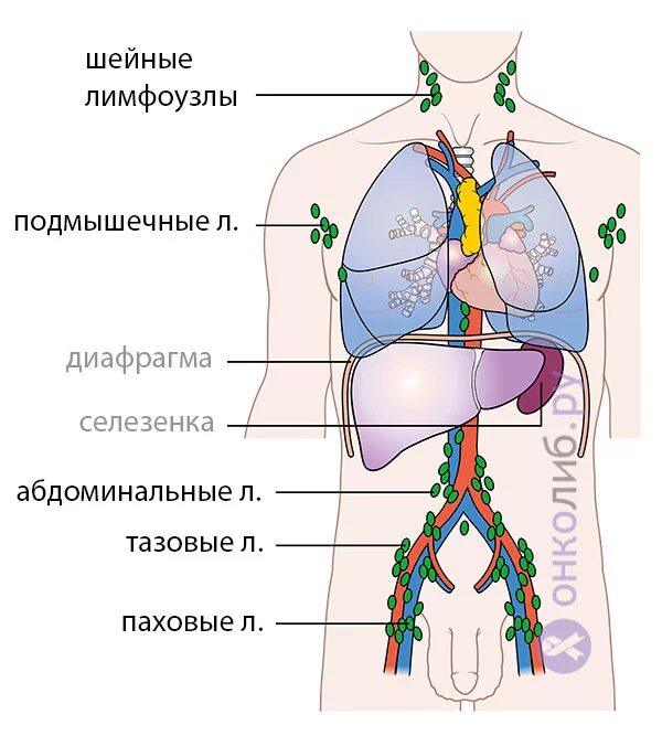 Лимфома Ходжкина паховые лимфоузлы. Лимфомы поражающие шейные лимфатические узлы. Поясничные лимфоузлы