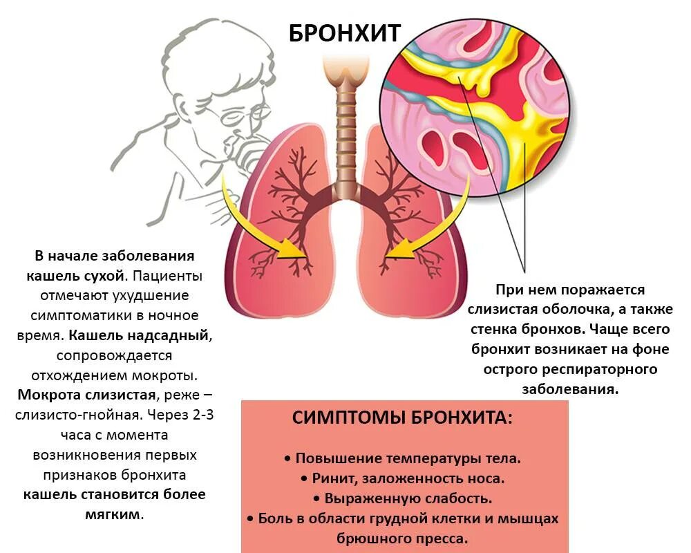 Признаки сильного кашля